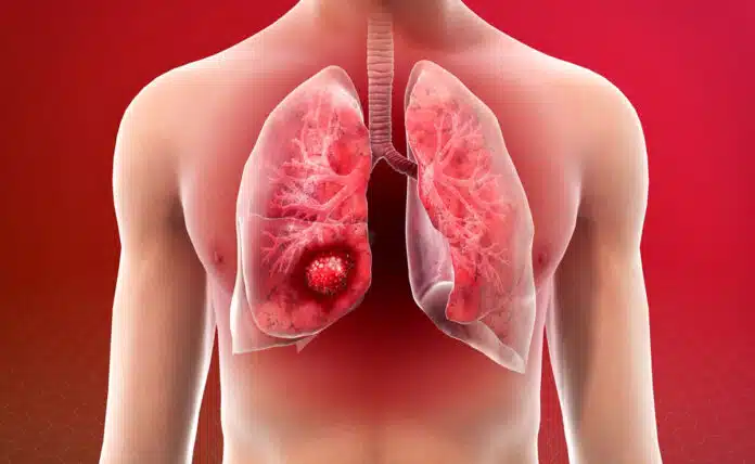 What are the main risk factors for Lung Cancer and how is it treated?