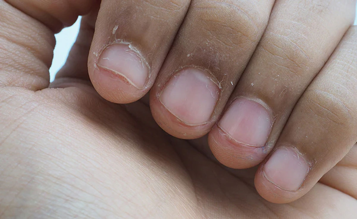 Is the skin around your nails peeling in winter? Try these home remedies for treatment and quick relief