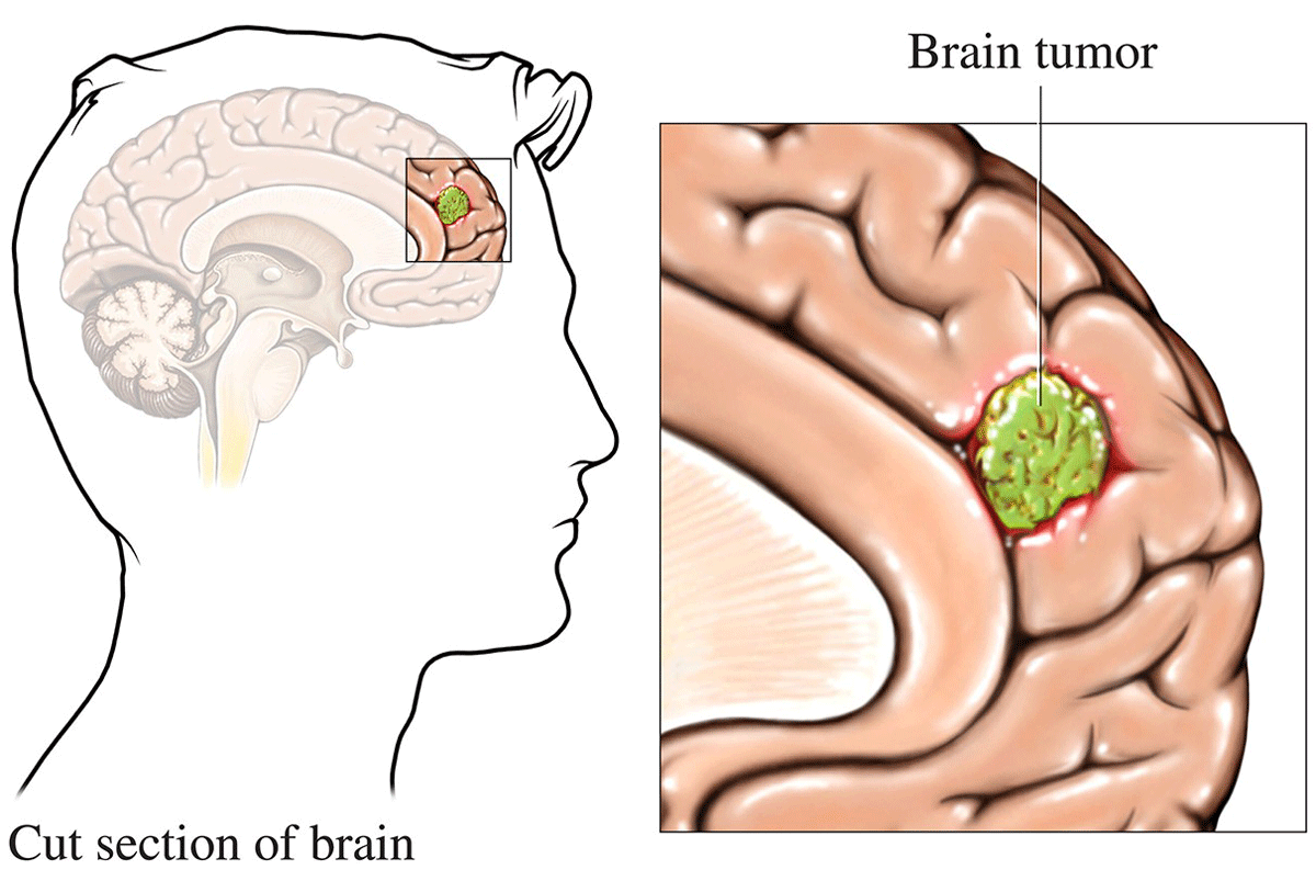 Understanding Brain Tumors: Causes, Symptoms, and Treatment Options