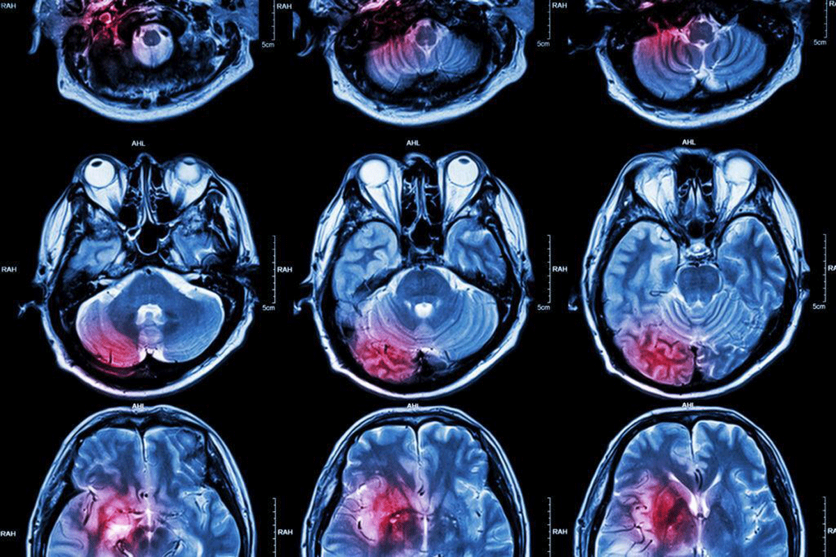 Understanding Brain Tumors: Causes, Symptoms, and Treatment Options