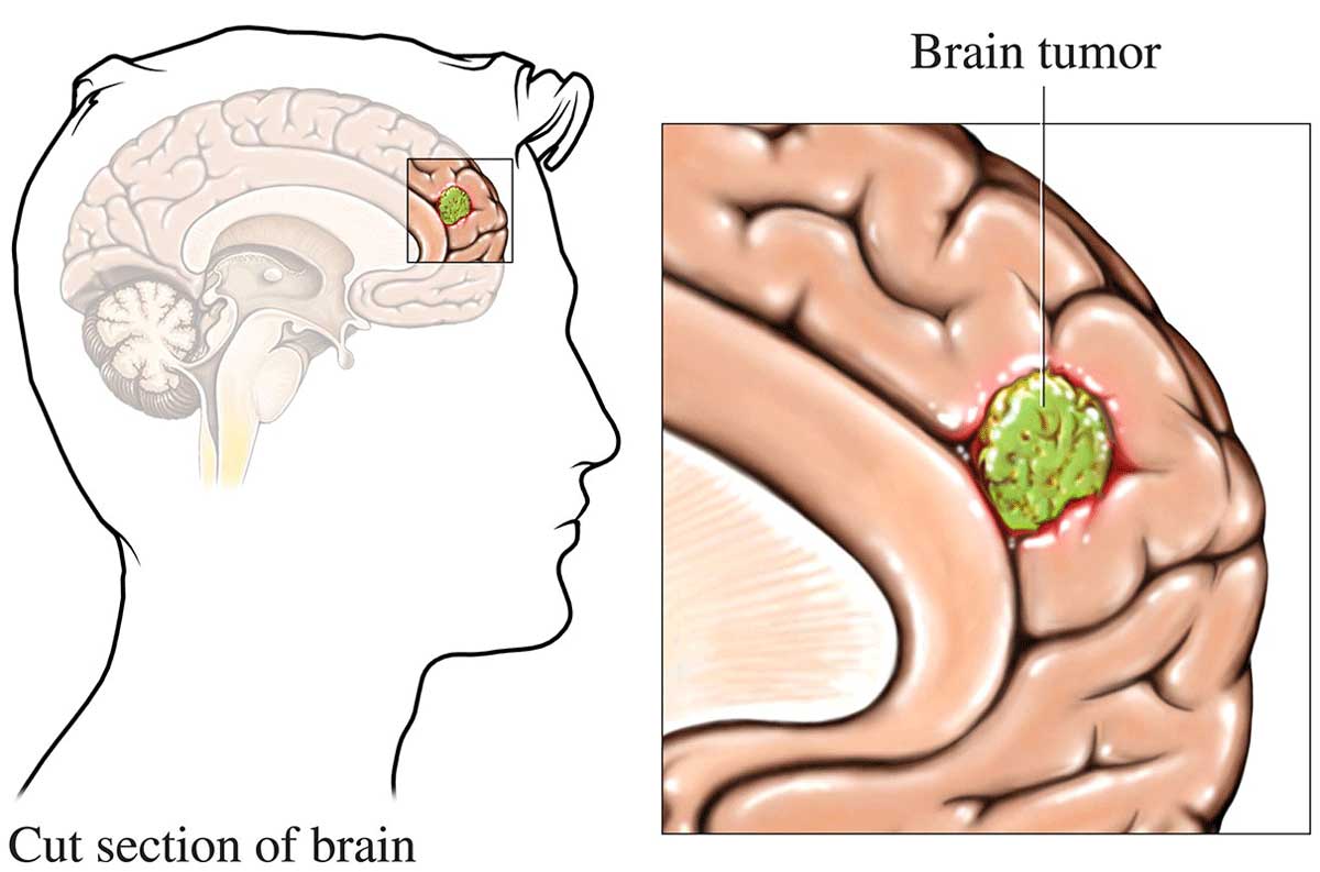 Understanding Brain Tumors Causes, Symptoms, and Treatment Options