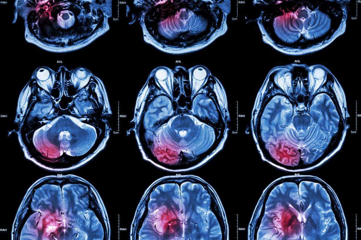 Understanding Brain Tumors Causes, Symptoms, and Treatment Options