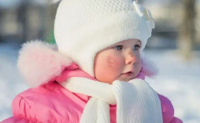 Protect your child from these common skin problems in winter, know the preventive measures.