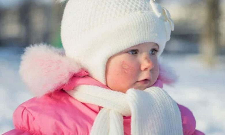 Protect your child from these common skin problems in winter, know the preventive measures.