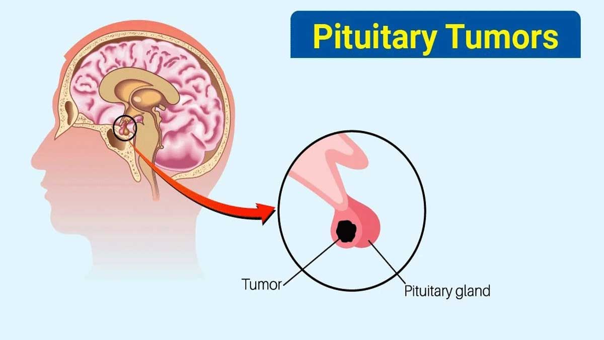 What are the different types of brain tumors