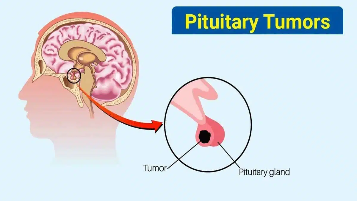 What are the different types of brain tumors