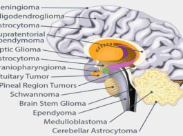 What are the different types of brain tumors