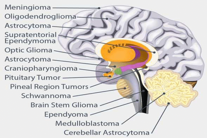 What are the different types of brain tumors