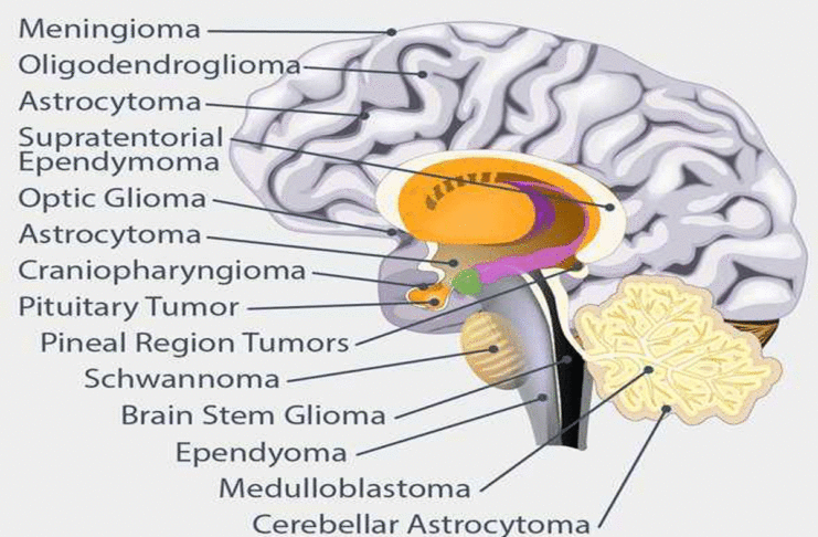 What are the different types of brain tumors