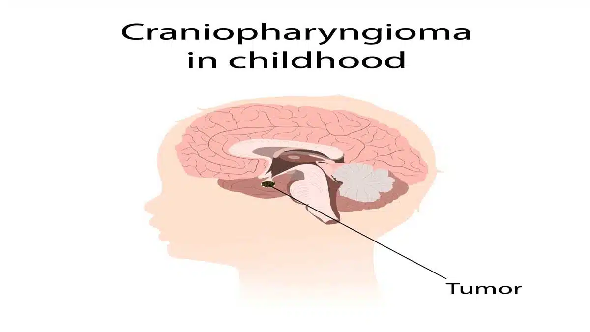 What are the different types of brain tumors