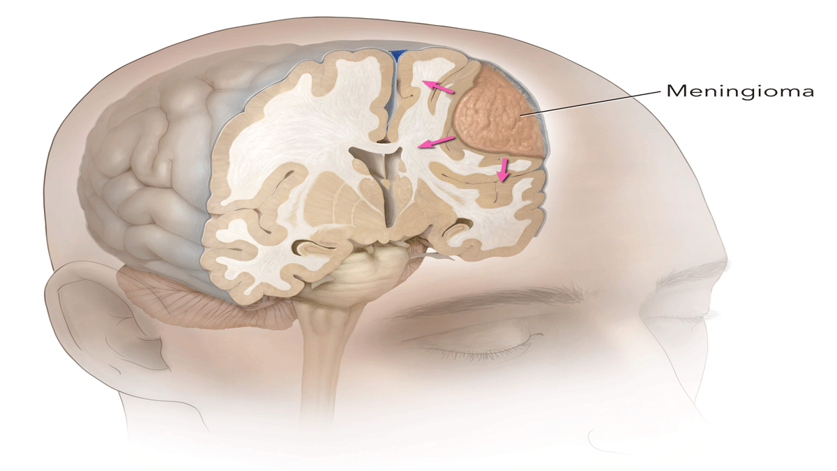 What are the different types of brain tumors