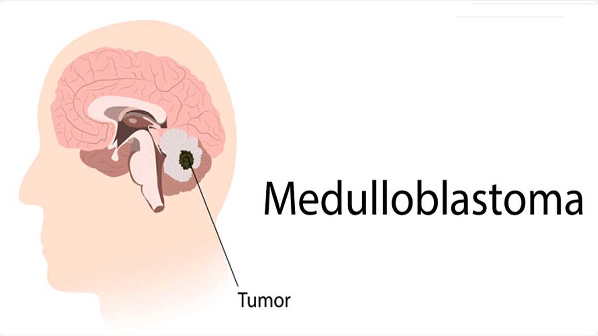 What are the different types of brain tumors