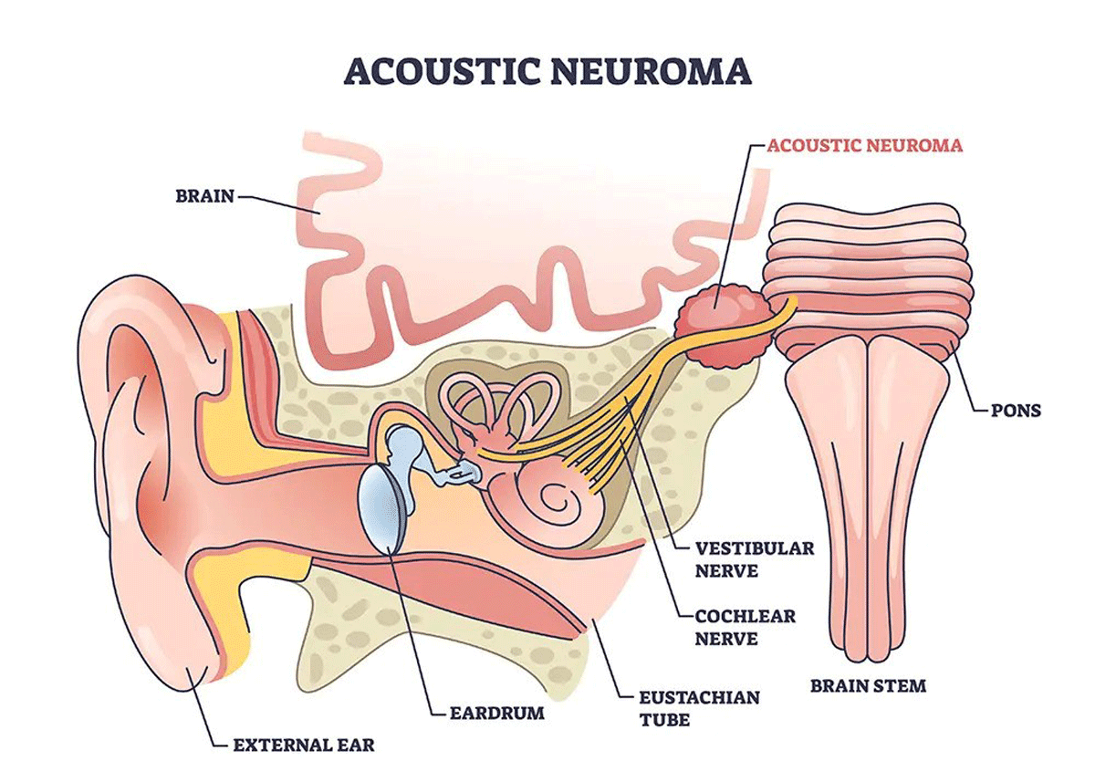 What are the different types of brain tumors