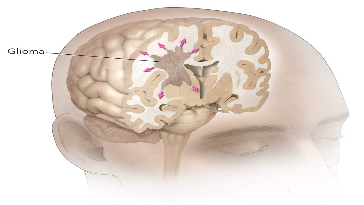 What are the different types of brain tumors