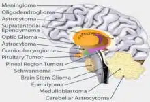 What are the different types of brain tumors