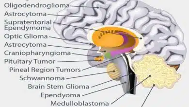 What are the different types of brain tumors