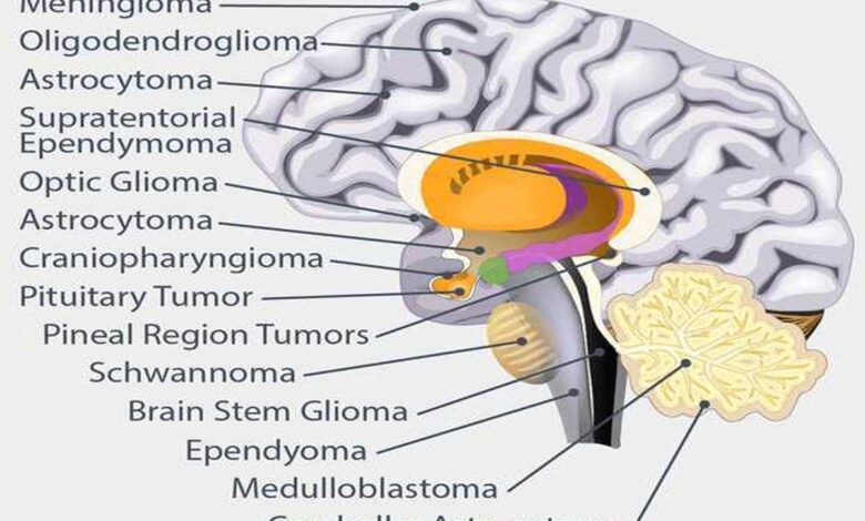 What are the different types of brain tumors