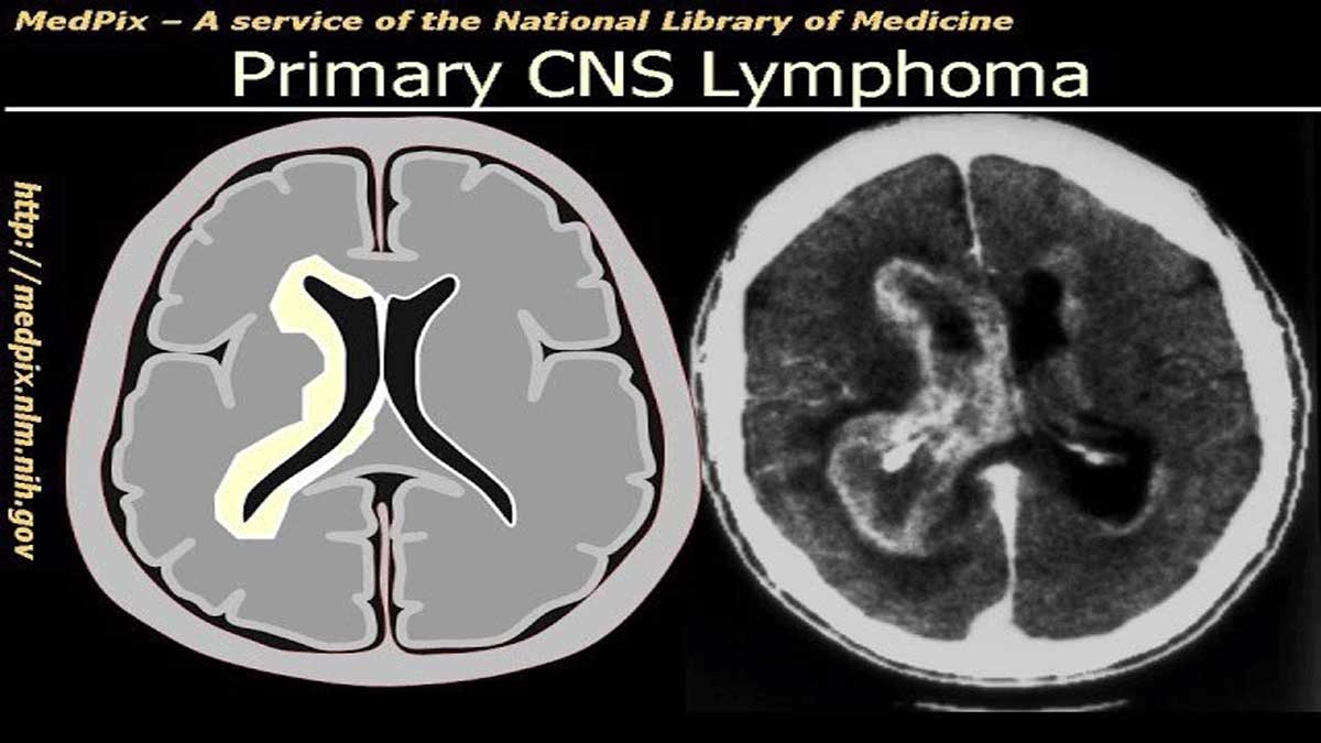 What are the different types of brain tumors