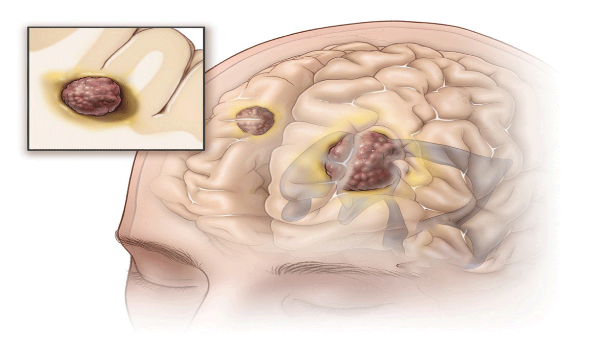 What are the different types of brain tumors