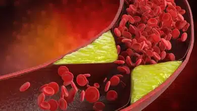 This winter vegetable helps in reducing bad cholesterol