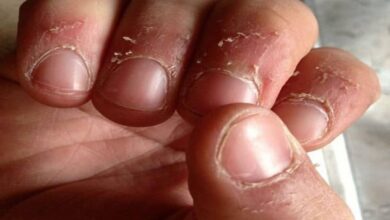 Is the skin around your nails peeling in winter? Try these home remedies for treatment and quick relief