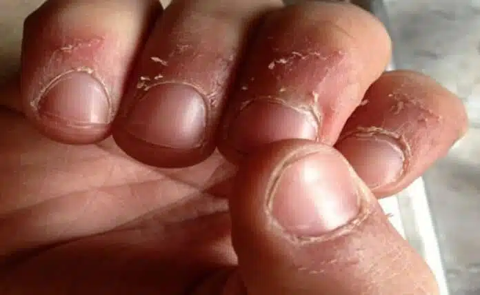 Is the skin around your nails peeling in winter? Try these home remedies for treatment and quick relief