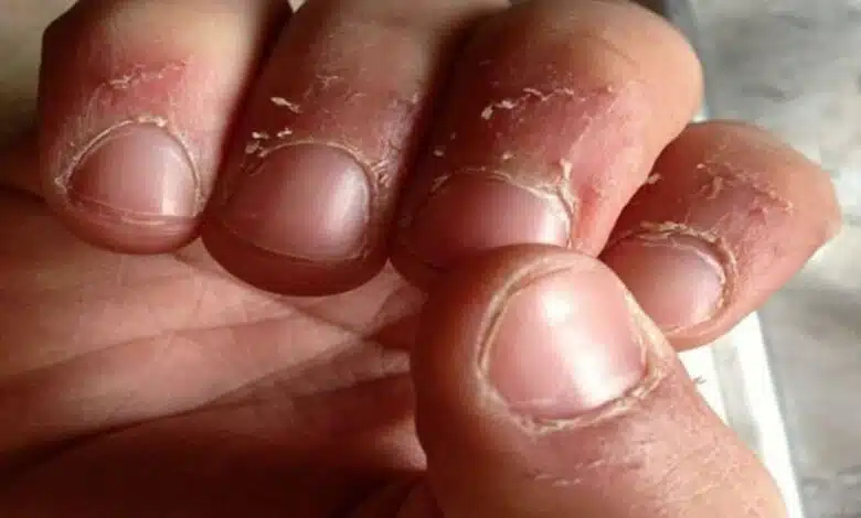 Is the skin around your nails peeling in winter? Try these home remedies for treatment and quick relief