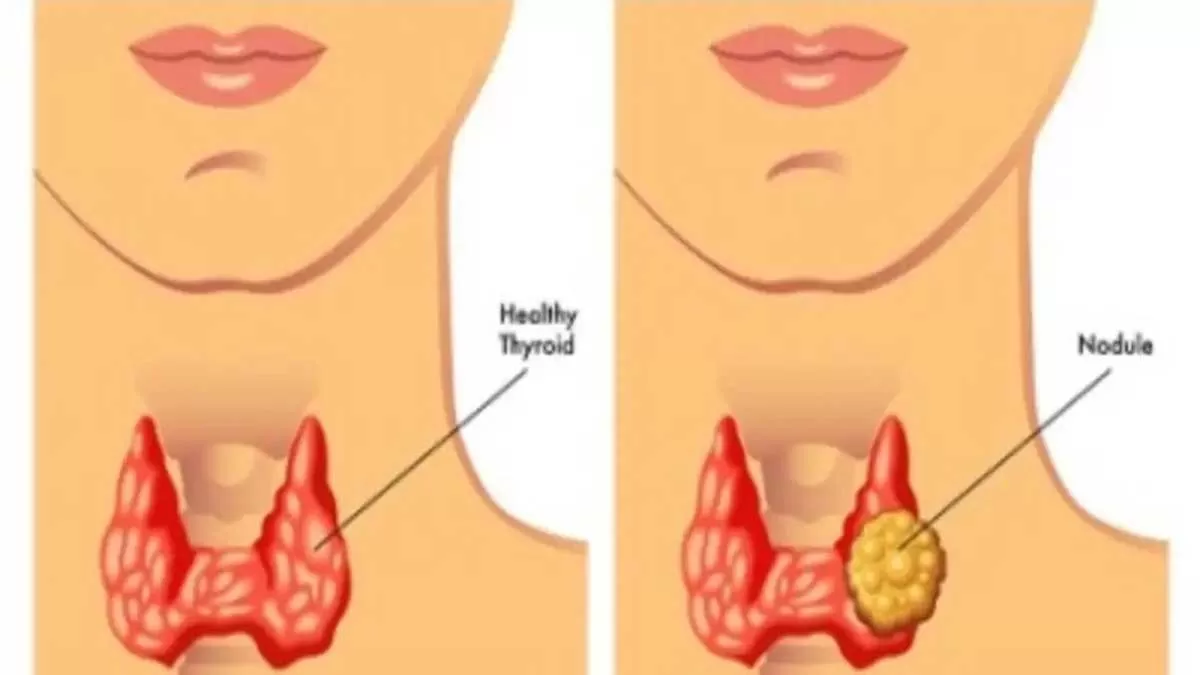 5 Common Thyroid Disorders