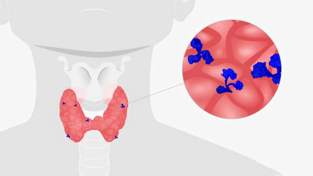 5 Common Thyroid Disorders