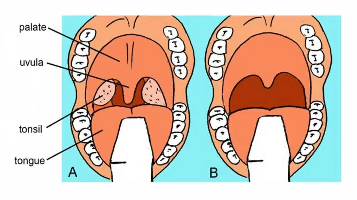 6 Types of Cleft Palate Surgery