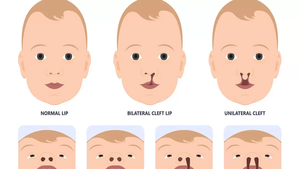 6 Types of Cleft Palate Surgery