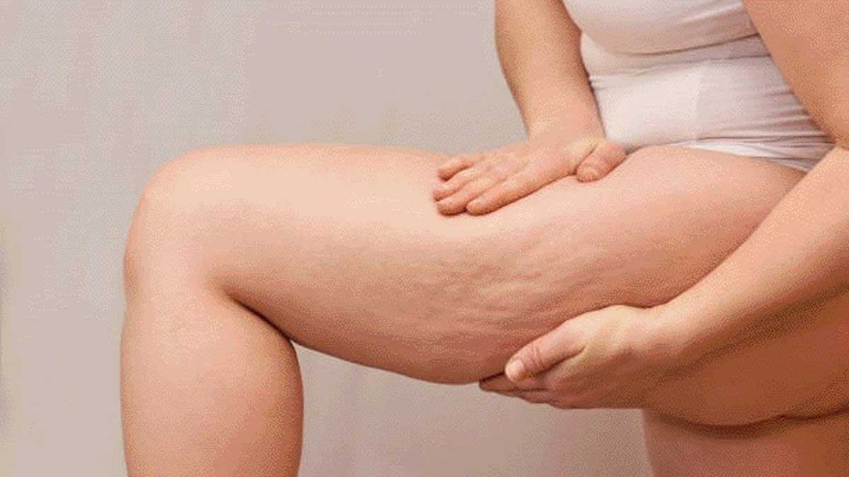 The hidden cause of fat in hips and thighs!