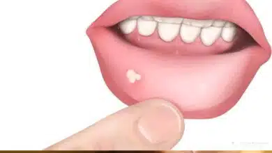5 home remedies to cure mouth ulcers naturally