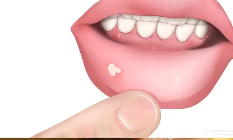 5 home remedies to cure mouth ulcers naturally