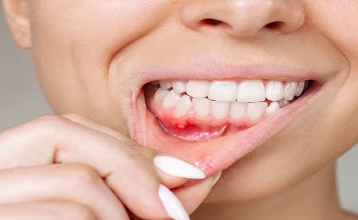 Mouth Ulcers