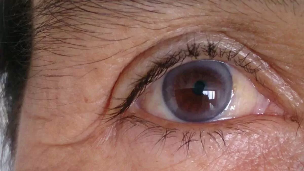 Symptoms of High Cholesterol in the Eyes