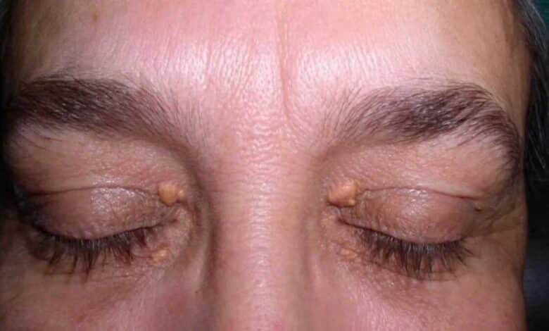 Symptoms of High Cholesterol in the Eyes