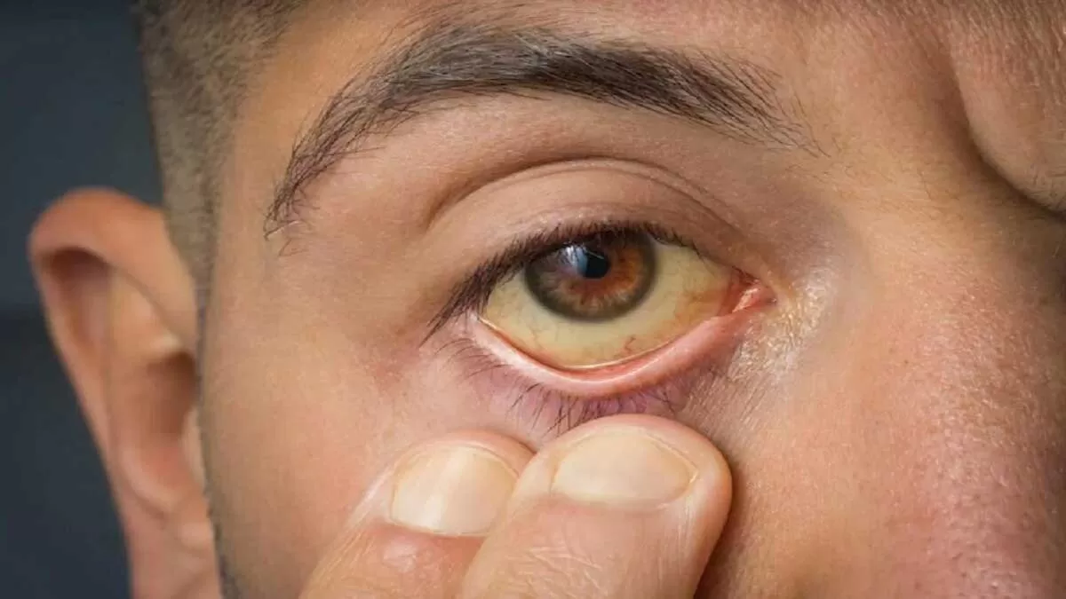 Symptoms of High Cholesterol in the Eyes