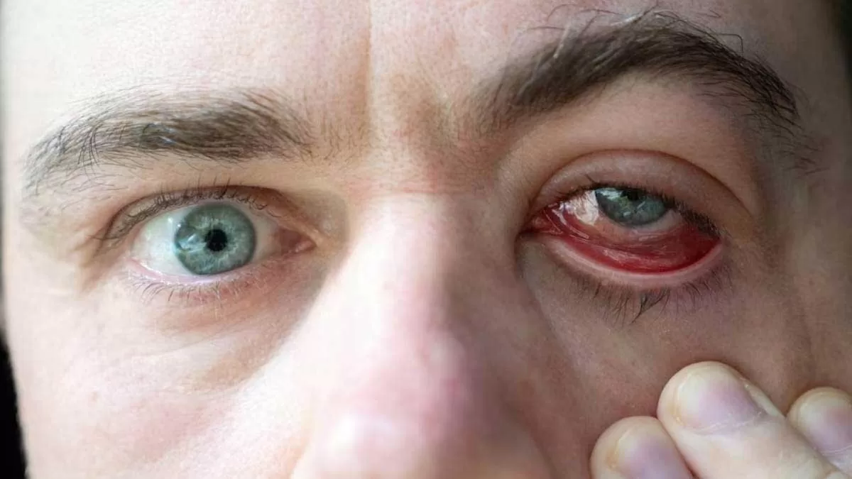 Symptoms of High Cholesterol in the Eyes