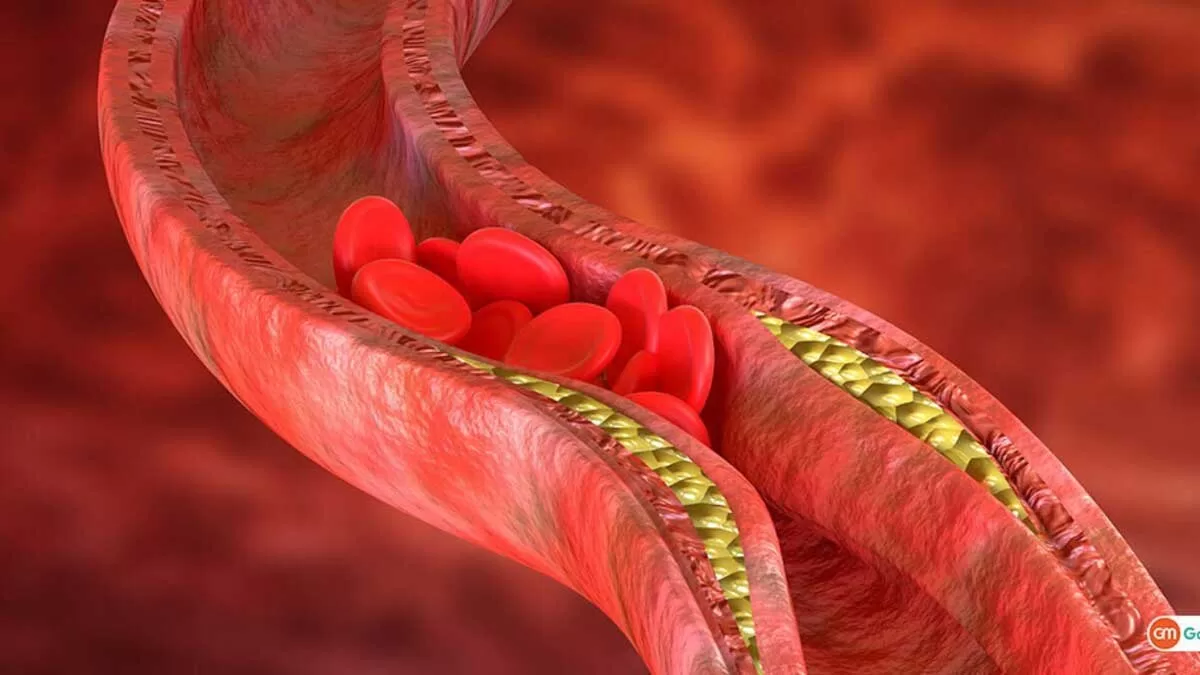 Symptoms of High Cholesterol in the Eyes