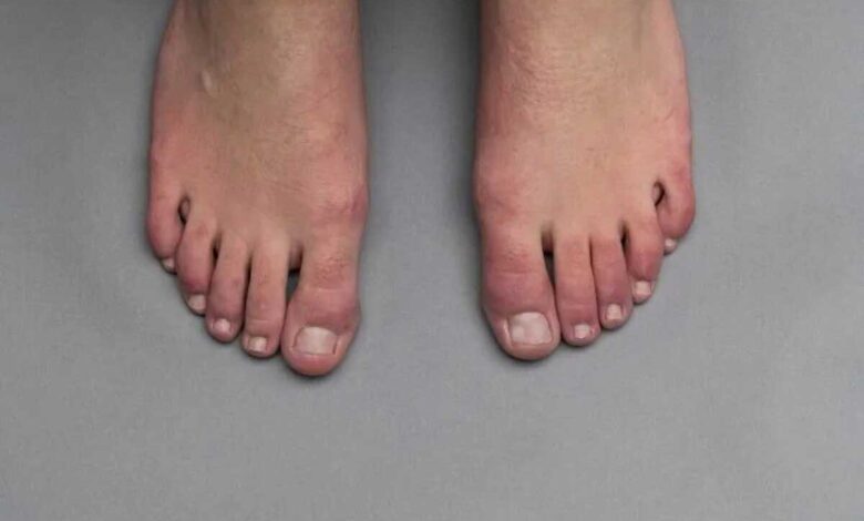 Understanding Chilblains