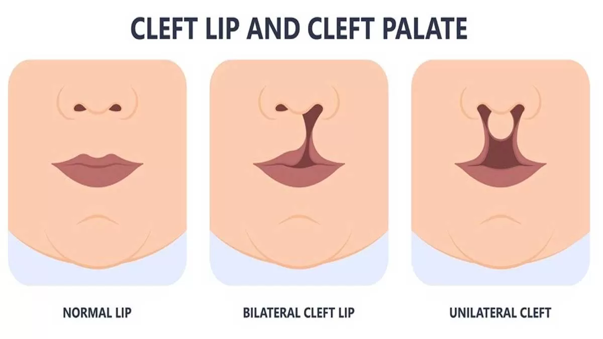 Understanding Cleft Palate