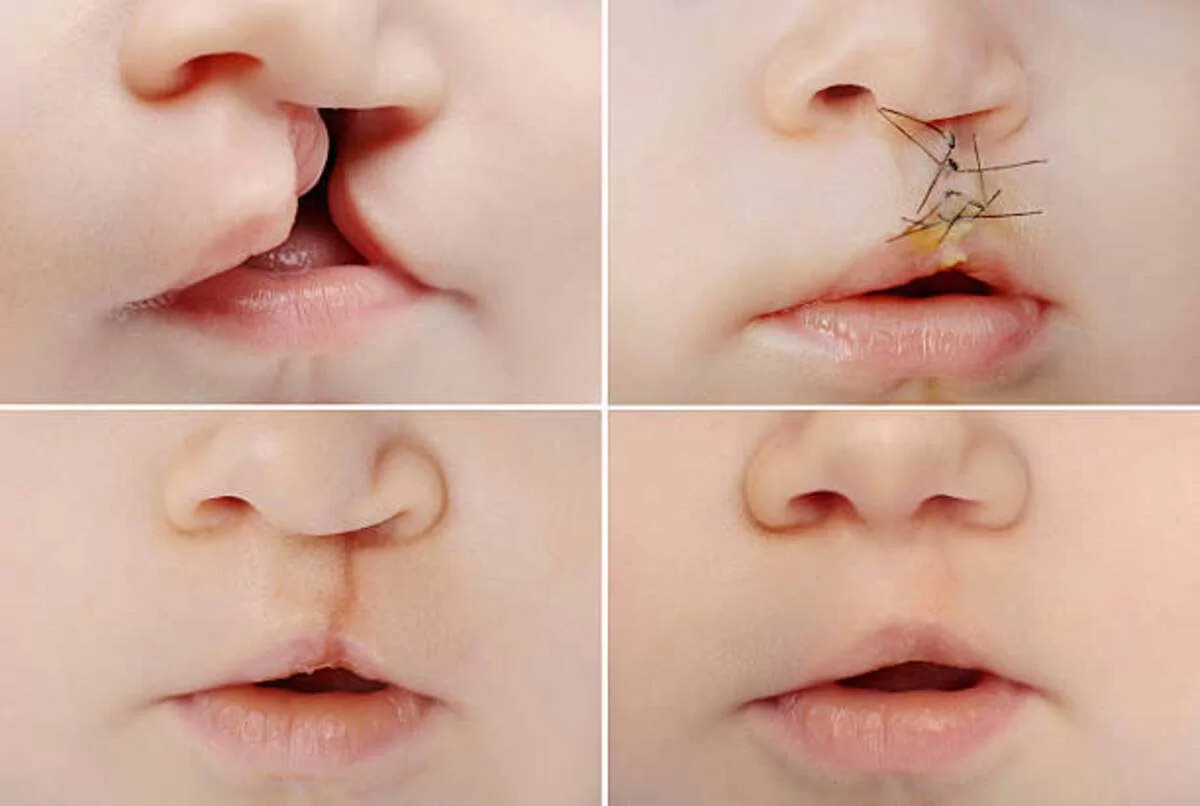 Understanding Cleft Palate