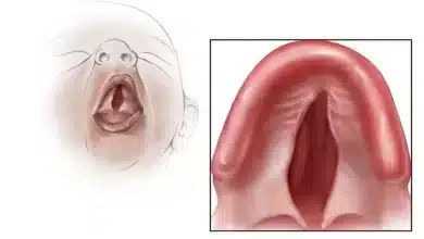Understanding Cleft Palate