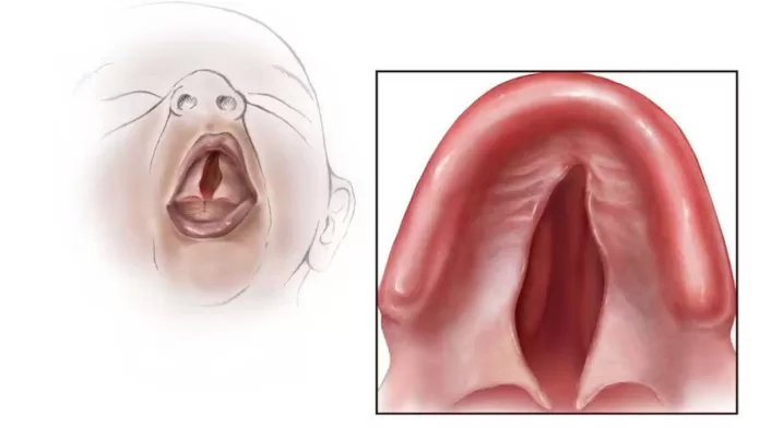 Understanding Cleft Palate