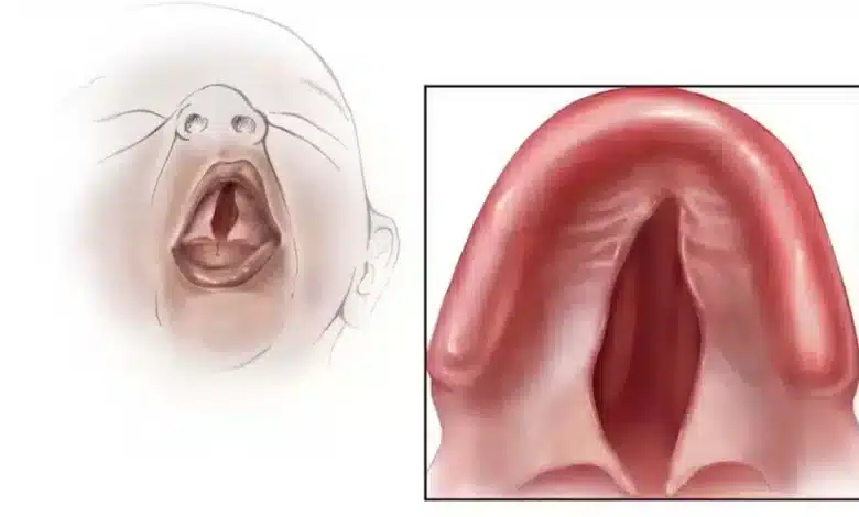 Understanding Cleft Palate