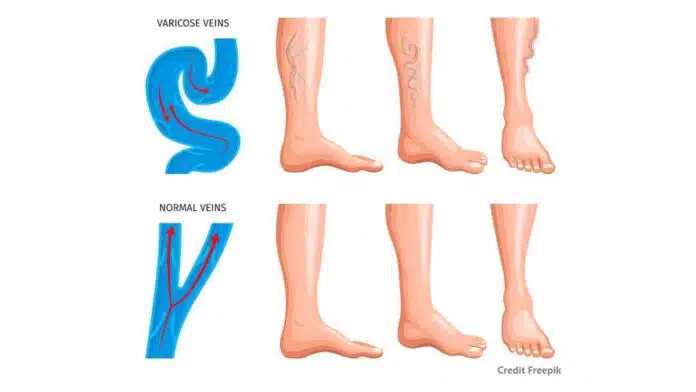 Understanding the Effects of Vein Bulges on Health