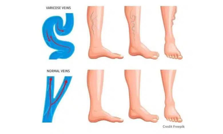 Understanding the Effects of Vein Bulges on Health