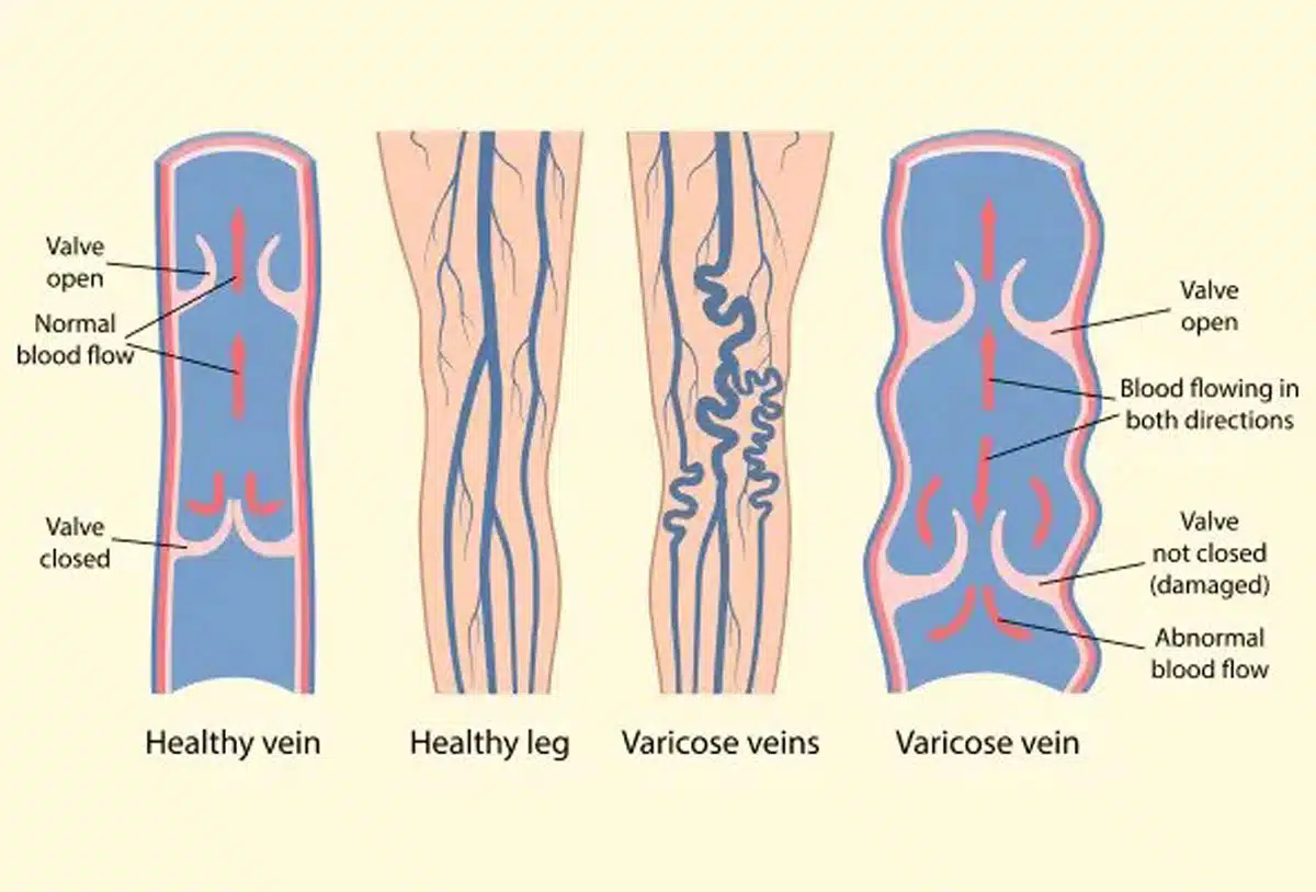 Understanding the Effects of Vein Bulges on Health