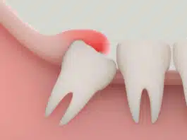 Wisdom Teeth A guide to your oral health